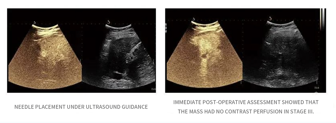 超声介入图1.jpg